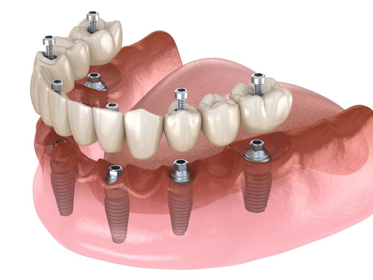 All-on-4 e All-on-6 — Dental Land