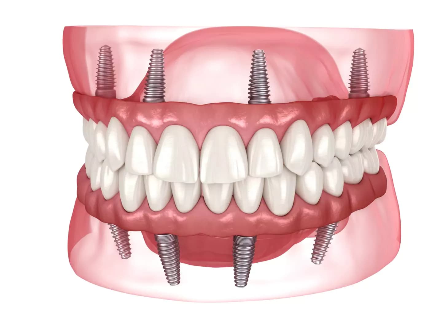 All-on-4 & All-on-6 — Dental Land