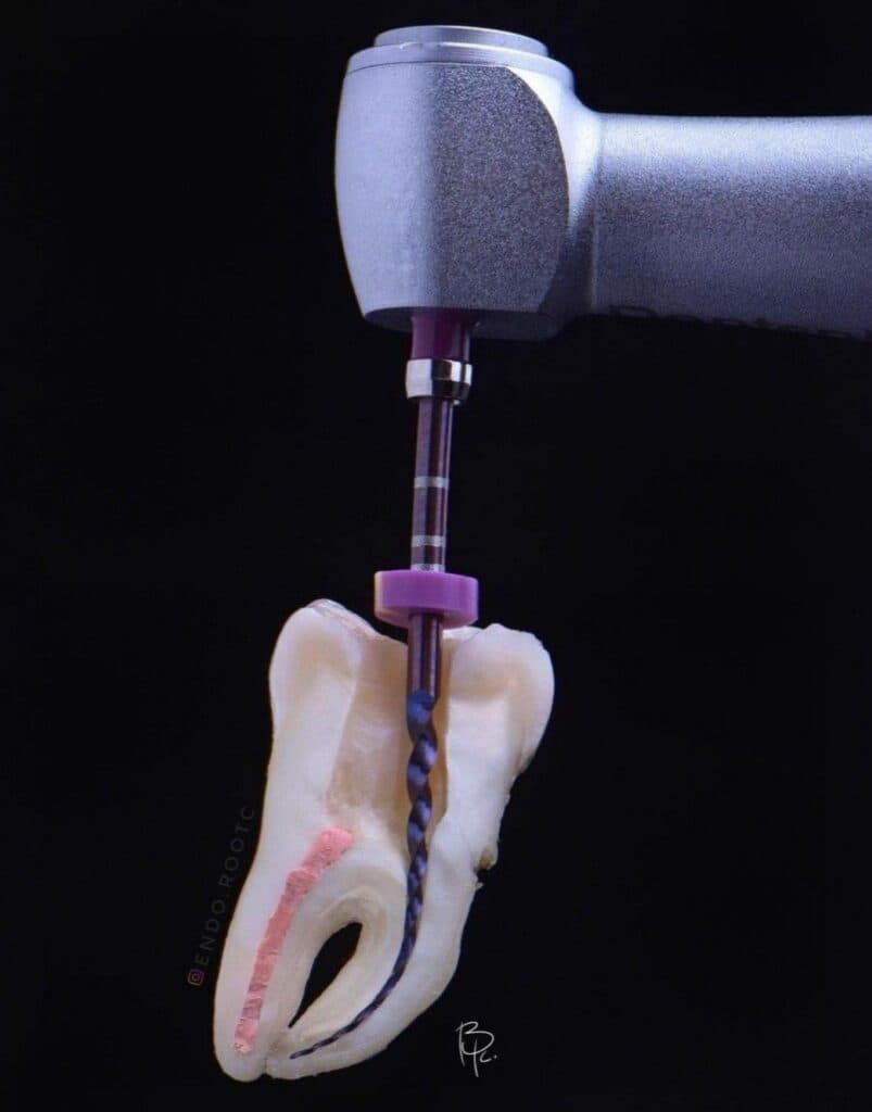 Endodoncia — Dental Land